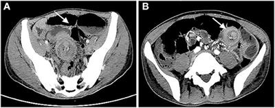 3D Laparoscopy-Assisted Operation to Adult Intussusceptions During Perioperative Period of Liver Transplantation: Case Report and Literature Review